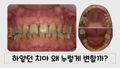 치아 착색은 왜 생기는걸까? 대표 이미지